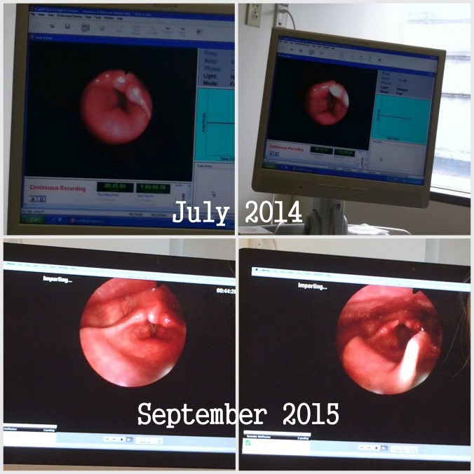 Matthew's vocal chords, 2014 and 2015.
